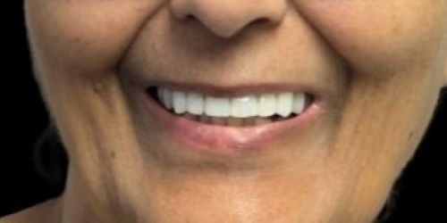 After upper all on x dental implant treatment showing restored smile same patient Orange County