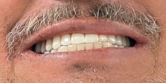 After front bridge tooth implant treatment showing restored smile same patient Orange County