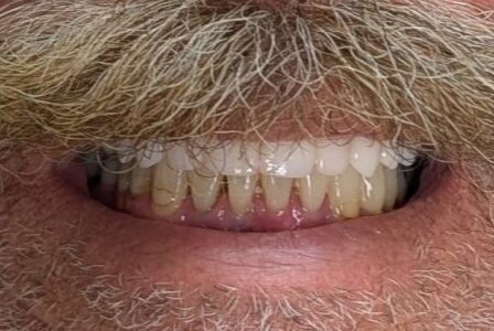 After dental implants same day smile broken teeth