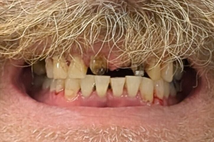 Before broken loose teeth